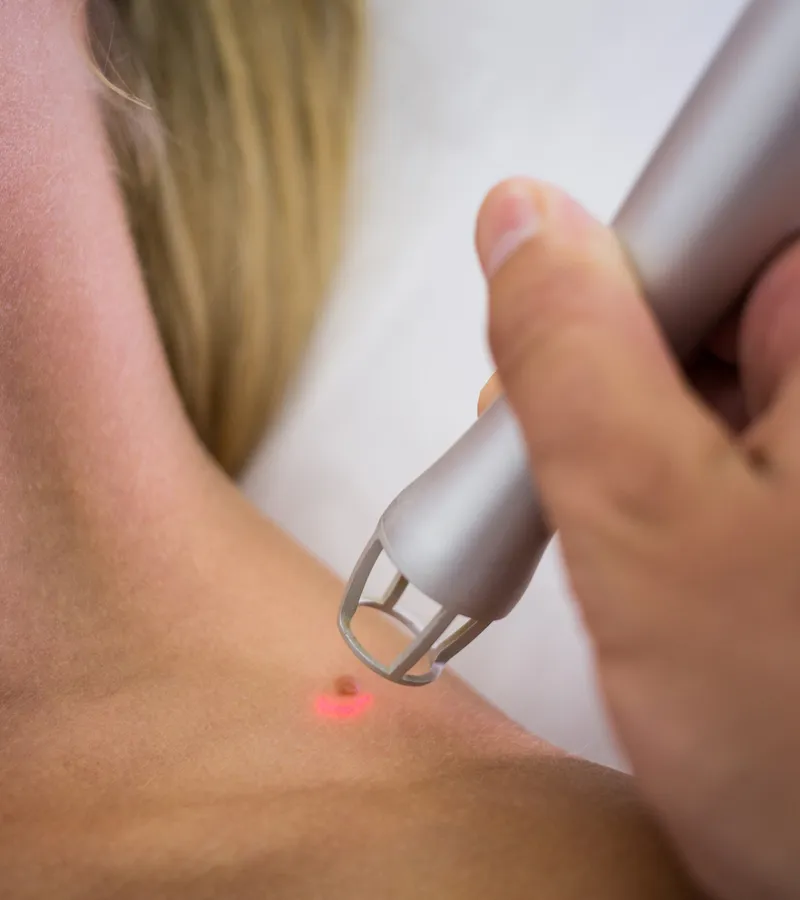 Dermatología en Creu Blava